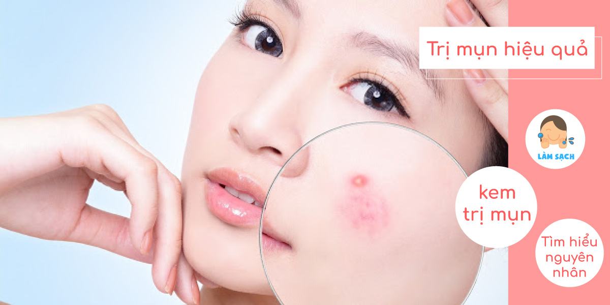 Review kem trị mụn hiệu quả nhất 2020