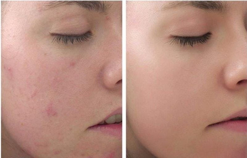 Peel da trị thâm là gì? Hiệu quả của peel da có tốt không?