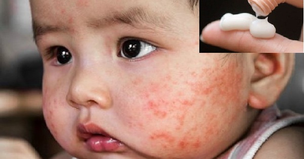Top 4 kem trị chàm sữa cho bé sơ sinh an toàn và tốt nhất