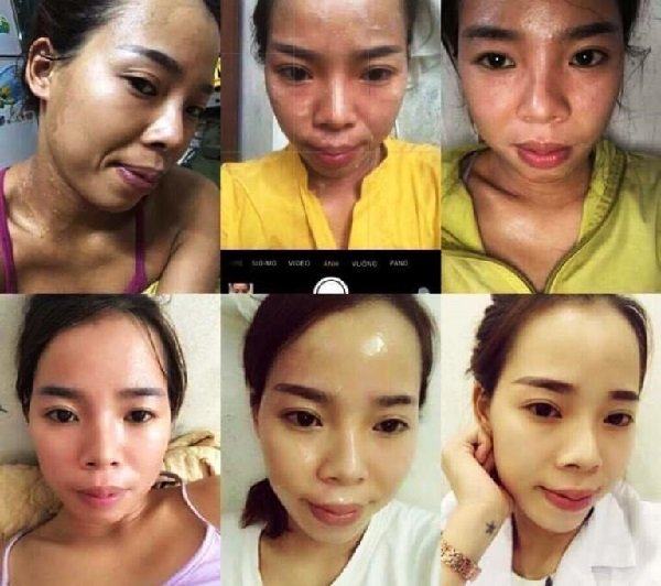 giai đoạn “tái tạo da” của 1 người mua kem tái hiện Chamomile