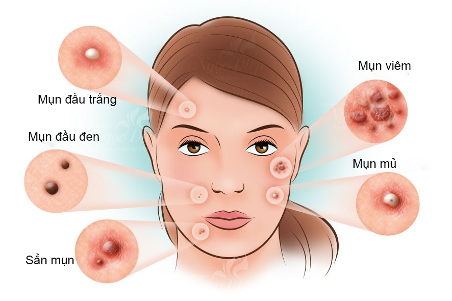 Nguyên nhân gây mụn là gì? Sữa rửa mặt trị mụn nào sạch nhất?
