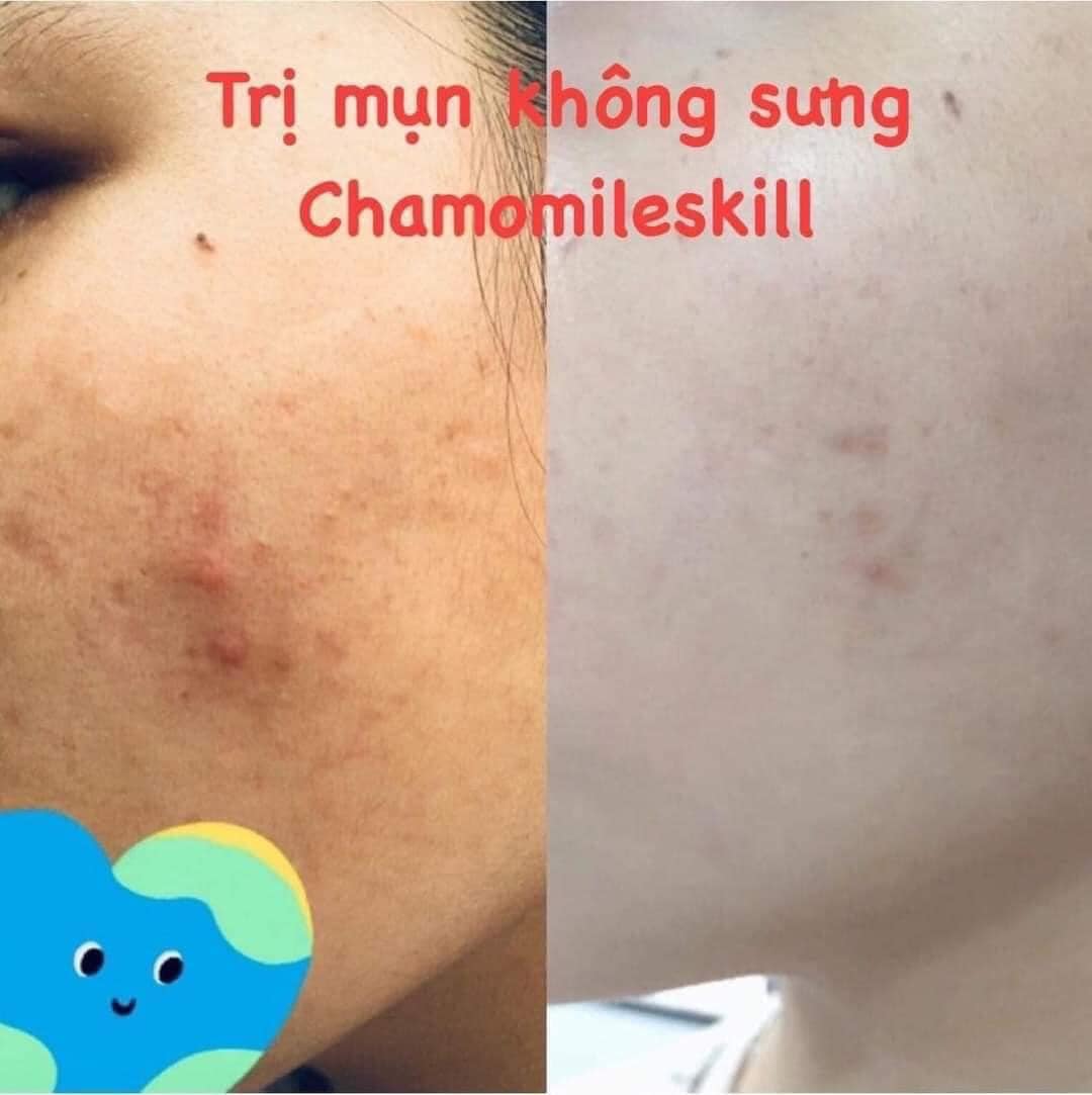Serum trị mụn không sưng Chamomileskill